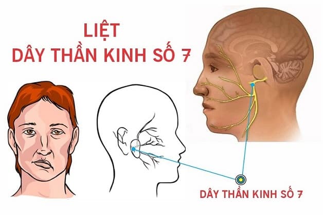 Dây thần kinh số 7 là gì?
