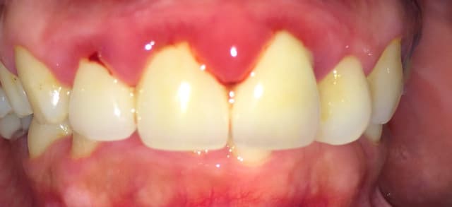 Lợi bị sưng là bệnh gì?