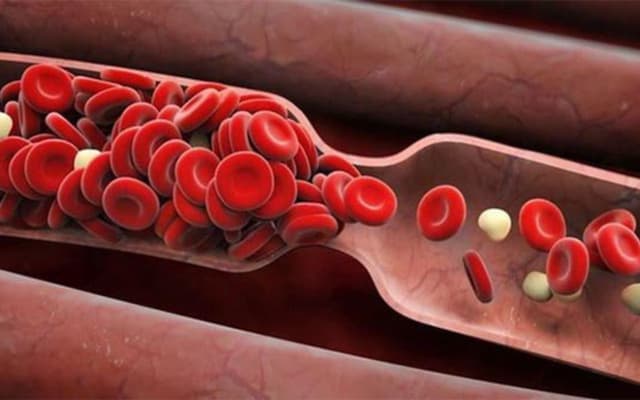 Cách làm lưu thông mạch máu não ngăn ngừa cơn tai biến