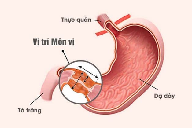 Hẹp môn vị gây ứ đọng thức ăn