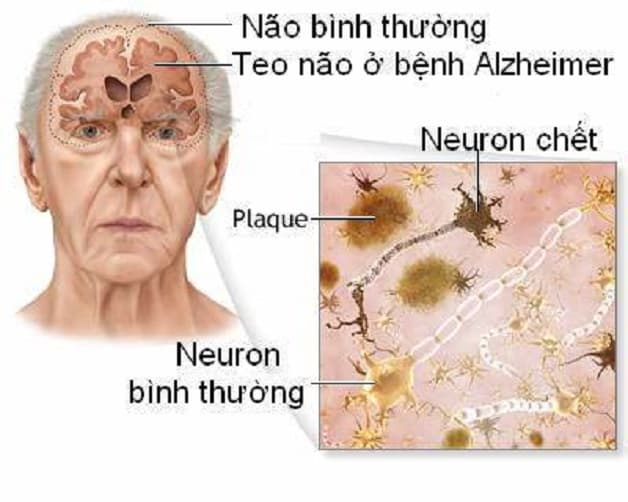 nguyên nhân gây sa sút trí tuệ