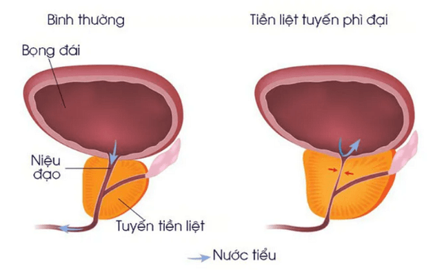 Phì đại tuyến tiền liệt là nguyên nhân sỏi bàng quang