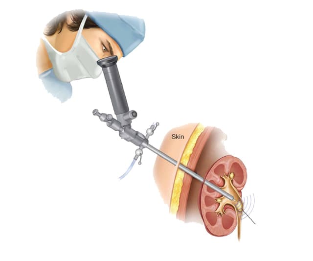 Những điều bạn cần biết về phương pháp tán sỏi qua da