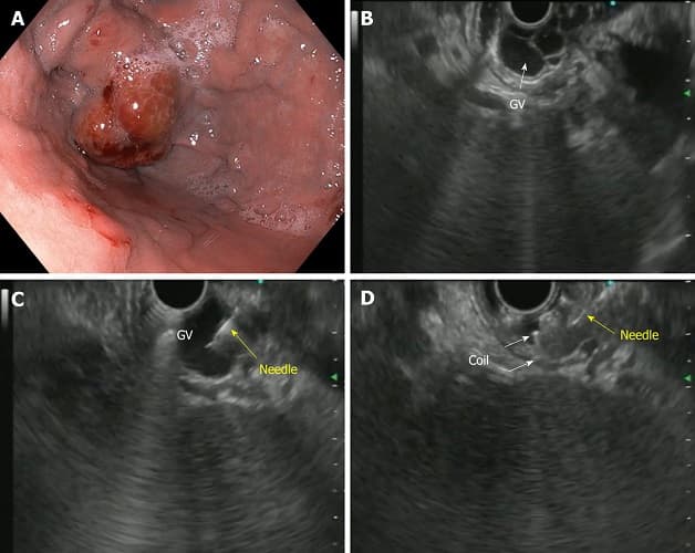 Tìm hiểu siêu âm nội soi (EUS) có tác dụng gì