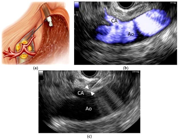 Thực hiện siêu âm nội soi (EUS) có tác dụng gì