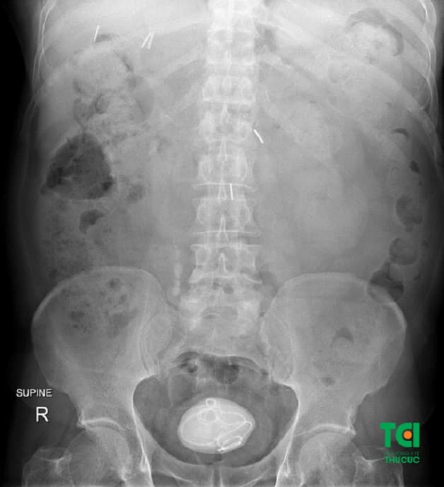 Sỏi bàng quang 10mm