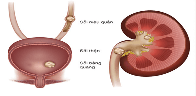 Góc giải đáp: sỏi niệu quản bao nhiêu thì phải mổ