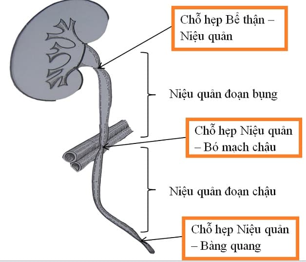 sỏi niệu quản nội thành bàng quang