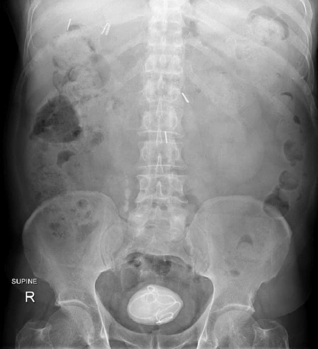 Chụp X - quang giúp đánh giá được tình trạng sỏi