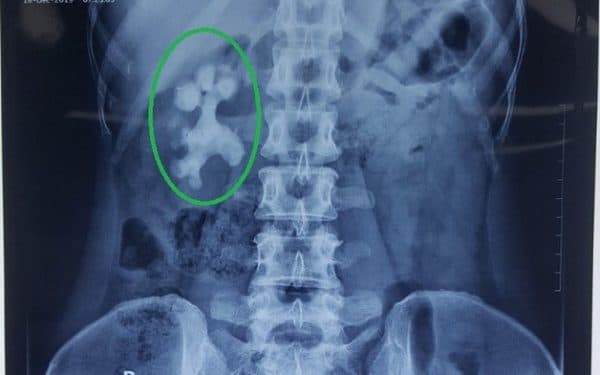 Sỏi niệu quản bao nhiêu thì phải mổ