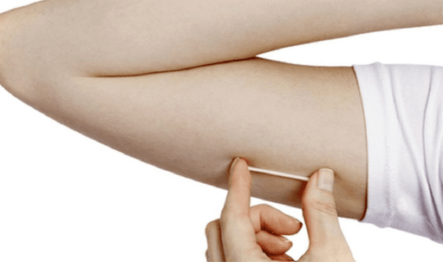 Cấy que tránh thai dưới da