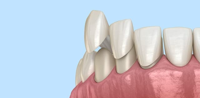 Giải đáp: Tại sao nên bọc răng sứ phục hình?