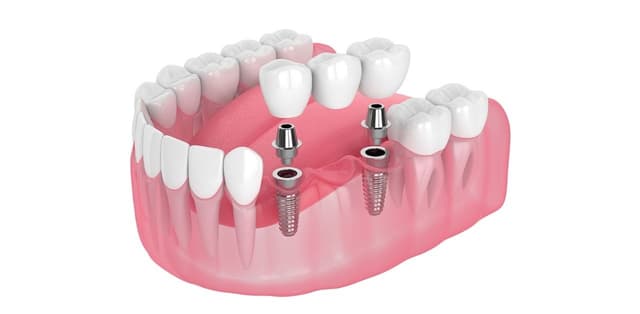 Tại sao phải cấy ghép Implant cho răng bị mất?