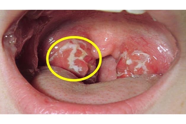 tầm soát ung thư vòm họng