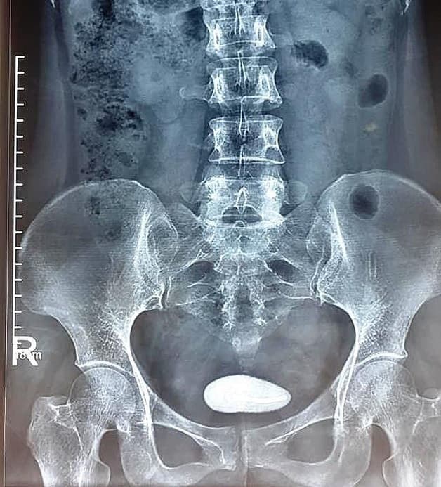 Đối với các loại sỏi có kích thước quá lớn vẫn cần phải sử dụng phương pháp mổ mở