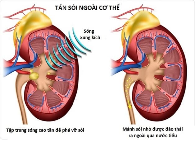 Phương pháp tán sỏi niệu quản ngoài cơ thể