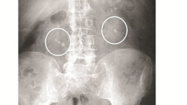 Bệnh nhân sẽ được thực hiển các chẩn đoán lâm sàng nhằm xác định tình trạng sỏi