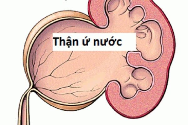 Sỏi bàng quang 5mm nguy hiểm không