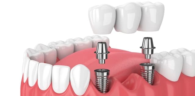 Tìm hiểu thời gian cấy ghép implant mất bao lâu?