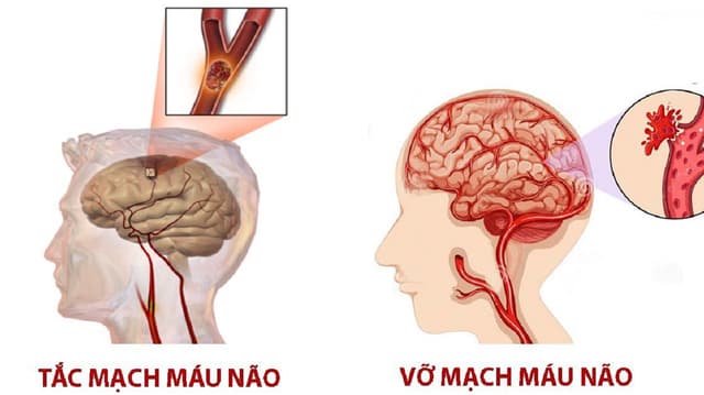 Tai biến: Nhận biết và cách xử trí như thế nào?