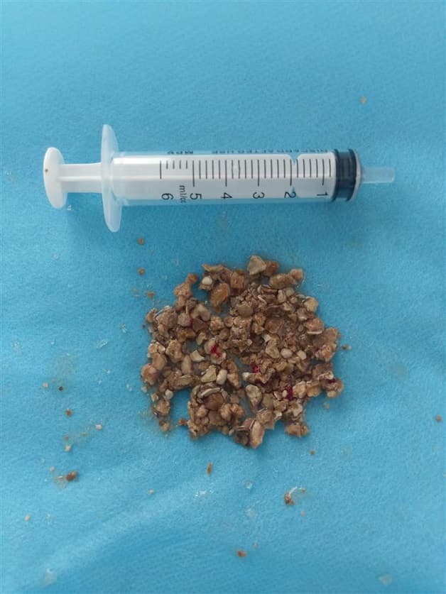 Sỏi bàng quang có nhiều hình dạng và kích thước khác nhau