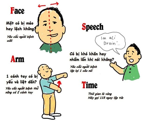 Triệu chứng của bệnh nhồi máu não