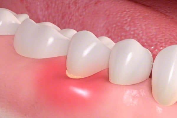 Triệu chứng viêm lợi thường gặp là sưng tấy nướu, có dịch mủ bất thường