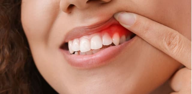 Nhận biết các triệu chứng viêm lợi và cách điều trị