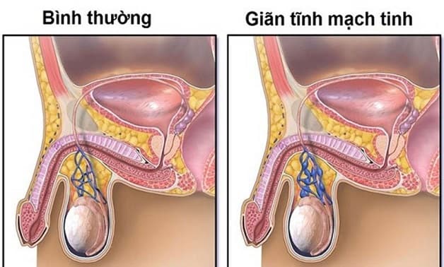 Giãn tĩnh mạch tinh hoàn nam giới