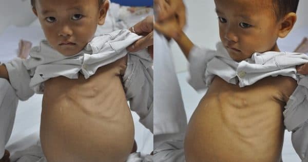 u gan nguyên bào và dấu hiệu nhận biết