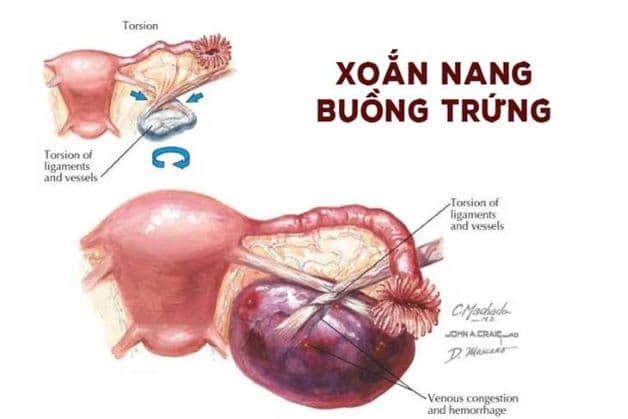Xoắn u nang buồng trứng