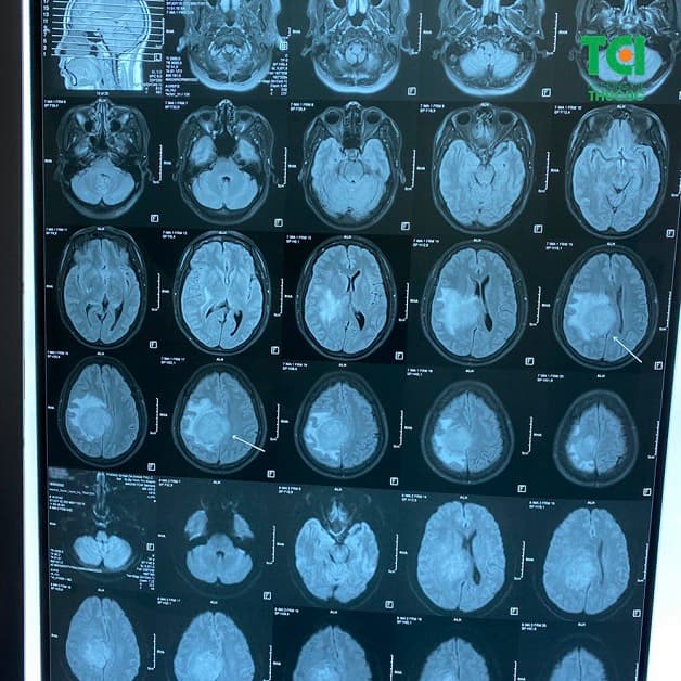 u não gây mất ngủ và đau đầu, buồn nôn