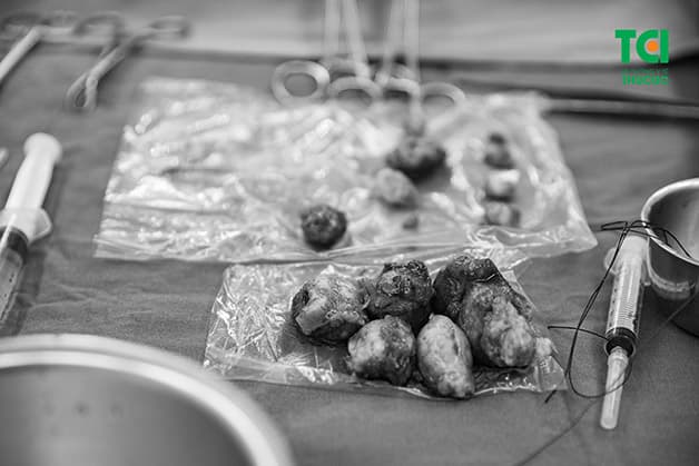 U xơ tử cung có nguy hiểm không luôn là thắc mắc thường trực của nhiều chị em