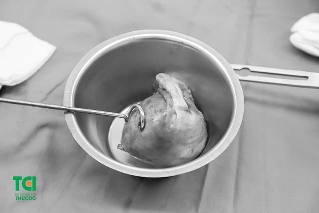 U xơ tử cung có nguy hiểm không và một số vấn đề chị em cần biết