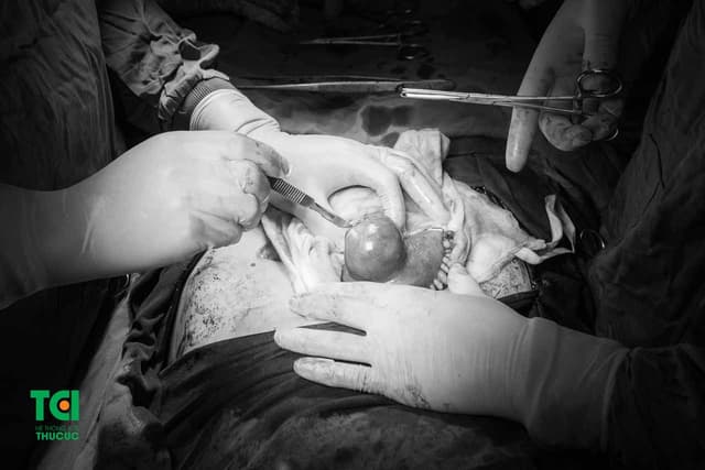 U xơ tử cung dưới thanh mạc có phải vấn đề đáng lo ngại?