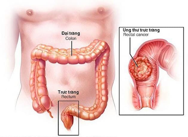 phát hiện ung thư đại tràng bằng cách nào
