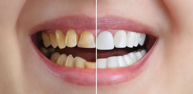 Giải đáp: Ưu điểm của dán sứ veneer là gì?