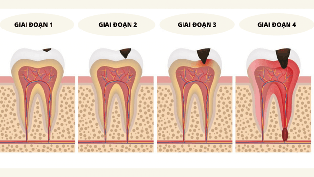 Viêm cuống răng do đâu? Chữa trị như thế nào?