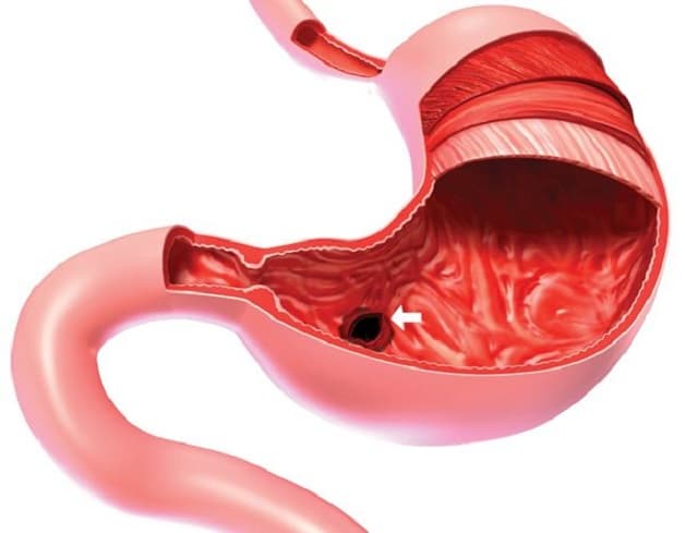 Viêm trợt dạ dày là gì?