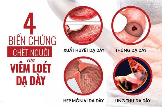 Viêm dạ dày có nguy hiểm không? Một số biến chứng rất nguy hiểm