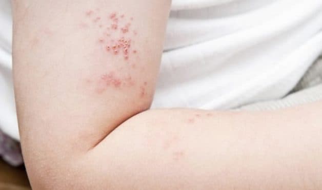 Bệnh zona có thể gây nhiễm trùng dây thần kinh và gây viêm