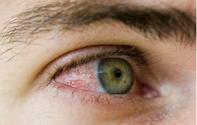 viêm màng bồ đào