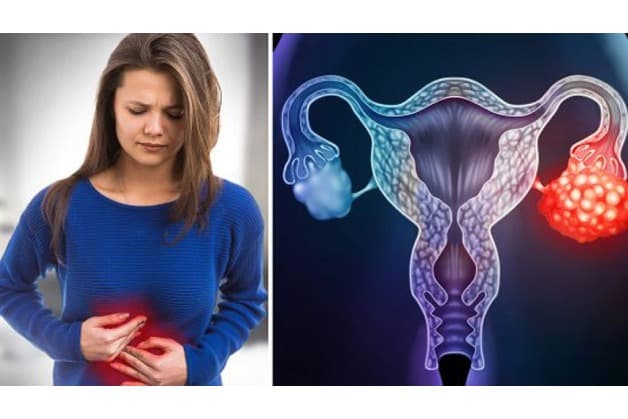 phương pháp tầm soát ung thư buồng trứng