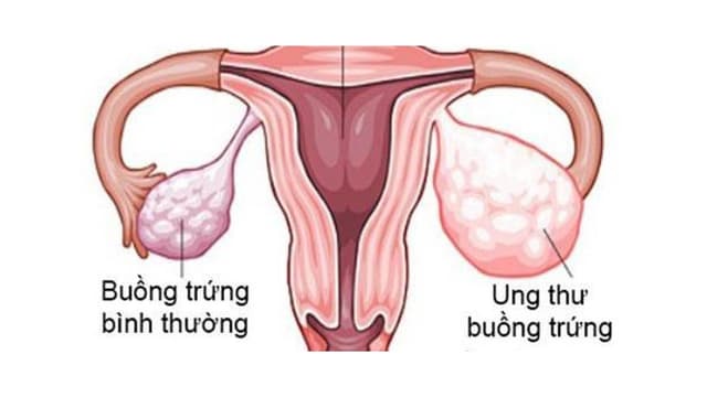 Một số phương pháp tầm soát ung thư buồng trứng hiệu quả hiện nay