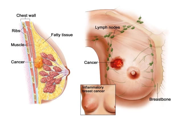 tầm soát ung thư vú như thế nào
