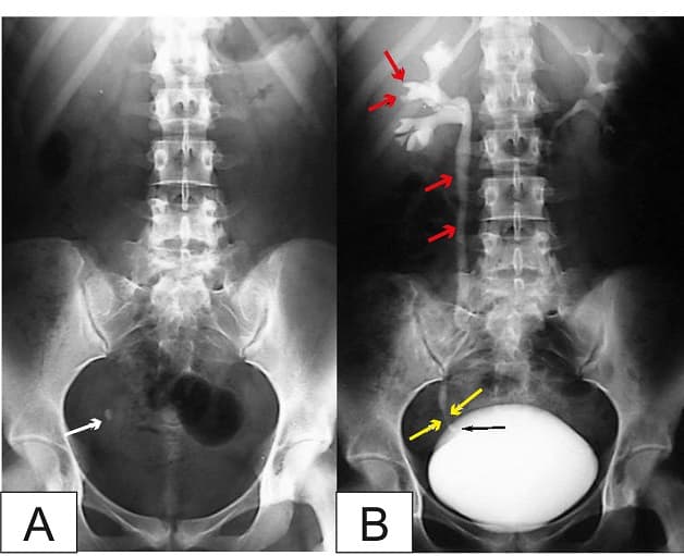 Chụp X - quang giúp xác định chính xác tình trạng của sỏi