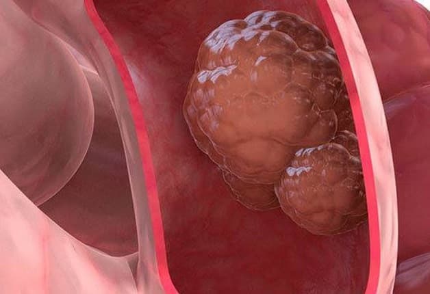 bệnh viêm loét trực tràng dẫn đến ung thư