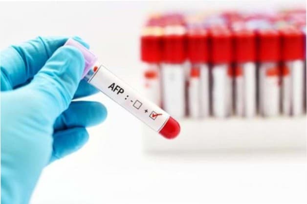xét nghiệm tầm soát ung thư gan