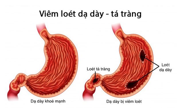 Vị trí các vết viêm loét dạ dày tá tràng