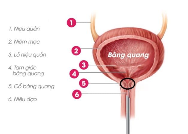 Sỏi bàng quang gây bí tiểu